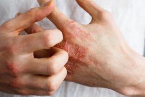 eczema alle mani