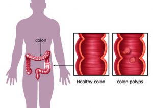 pulizia del colon regolare e controllo